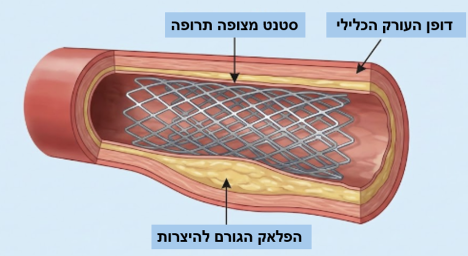 סטנט מצופה תרופה בעורק כלילי